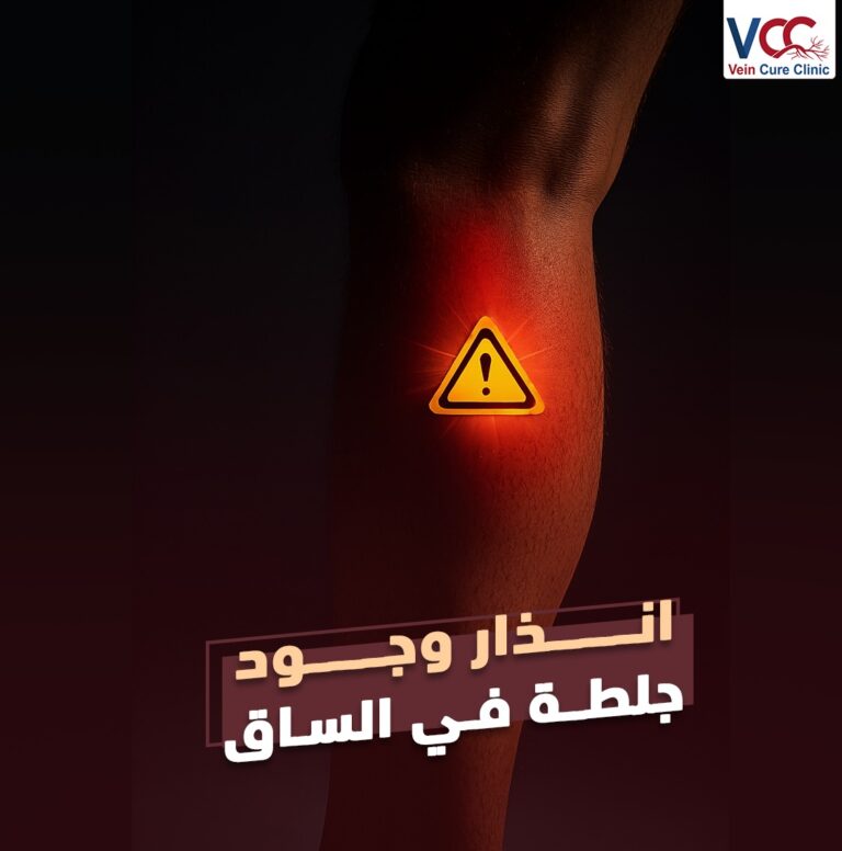 علامات مهمة بتقول إن فيه جـــلطة في الساق