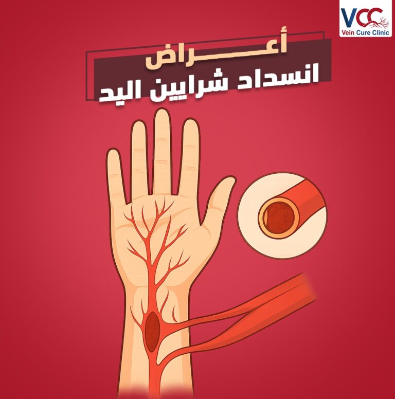 أعــــراض انـــسداد شـــــرايين الــــيد