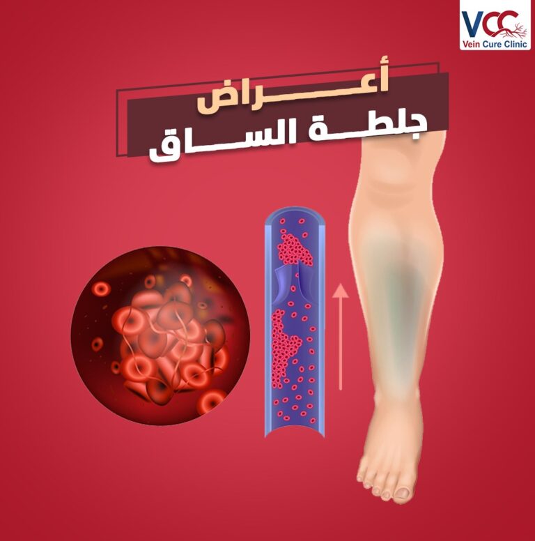 اعرف أكثر عن أعـــراض جلــطة الســـاق👌