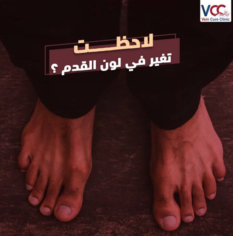 لاحظـــــت تغيــــر في لــــون القــــدم ؟