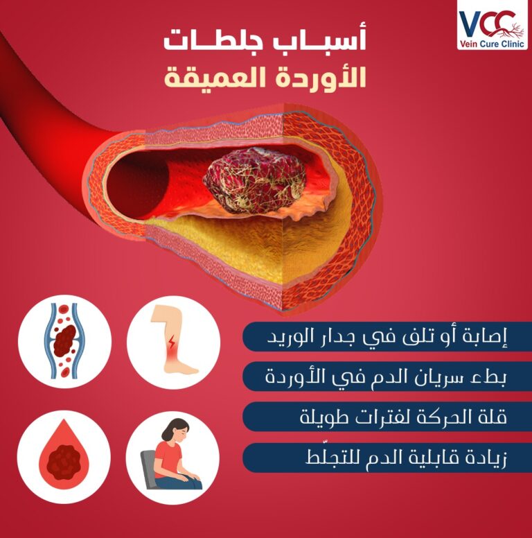 الإهمال خطر حقيقي؛ لأن جلطة الأوردة العميقة ممكن تتحرك من مكانها وتوصل للرئة،