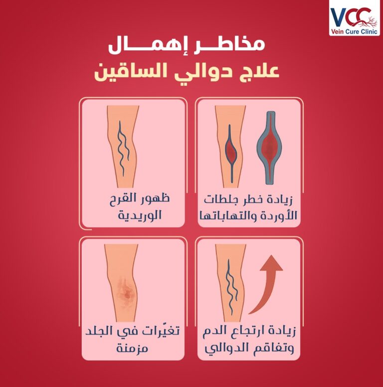 متهملش علاج الدوالي لتجنب مضاعفات ممكن تأثر على صحتك