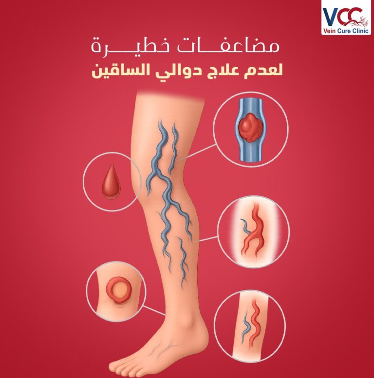 مضاعفات ممكن تحصل عند إهمال علاج دوالي الساقين