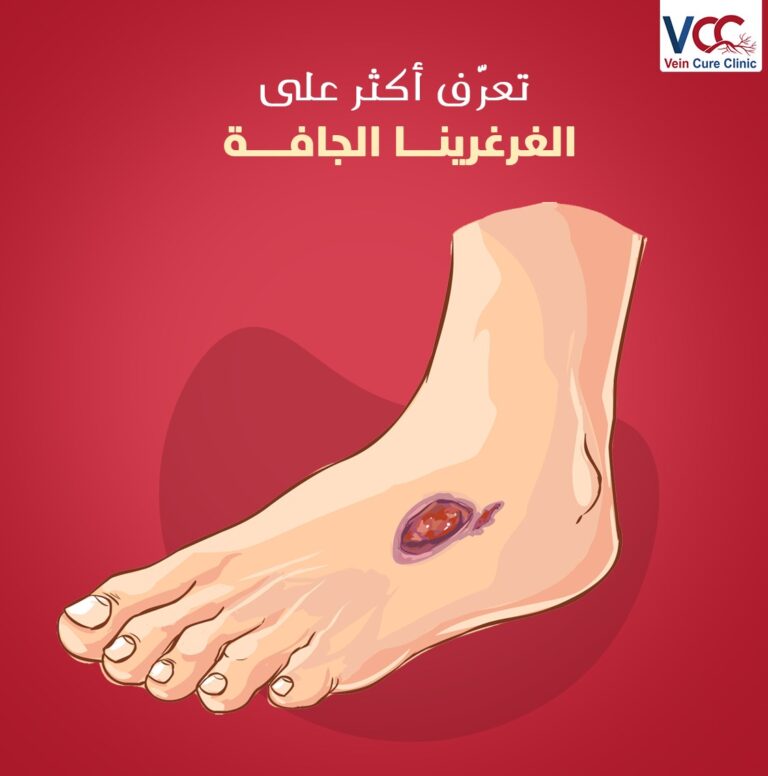 اعرف أكتر عن الغرغرينا الجافة