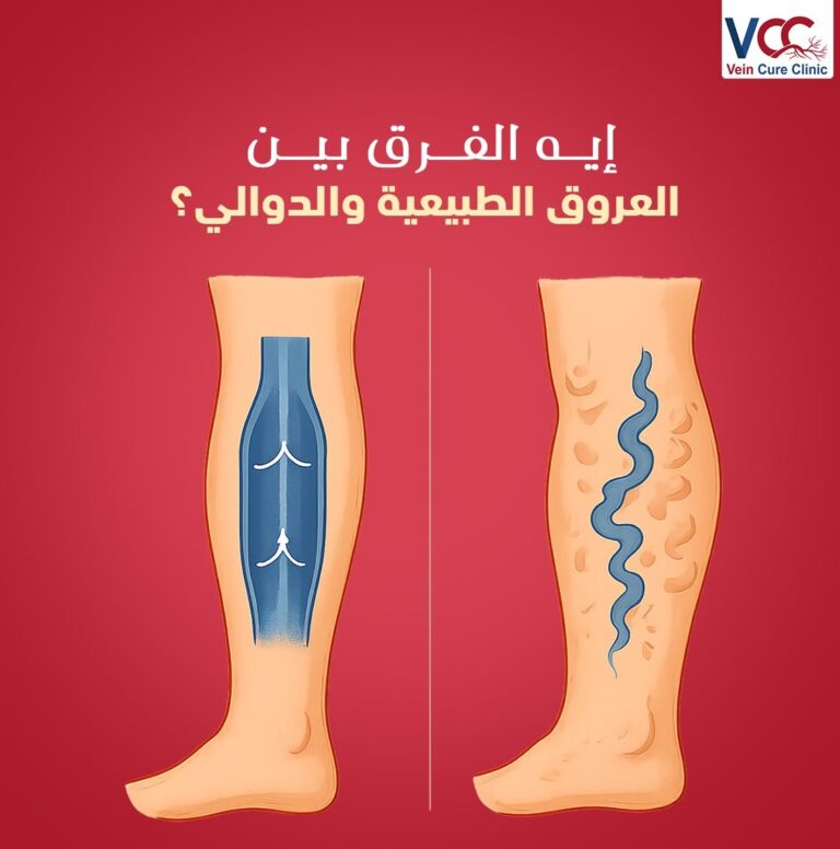 إيه الفرق بين العروق الطبيعية والدوالي؟