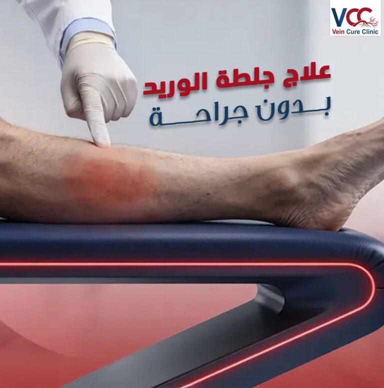 ازاي بنعالج جلطة الوريد بدون جراحة؟
