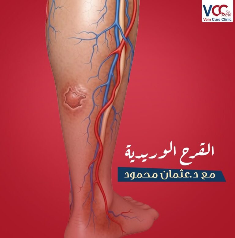 القرح الوريدية مع د. عثمان محمود