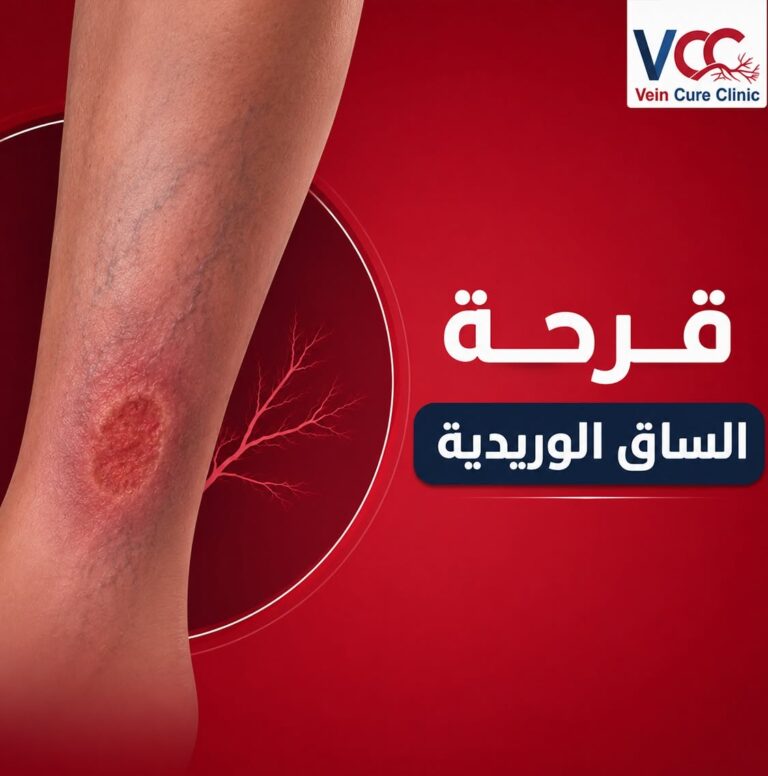 قرحة الساق الوريدية مع د.عثمان محمود