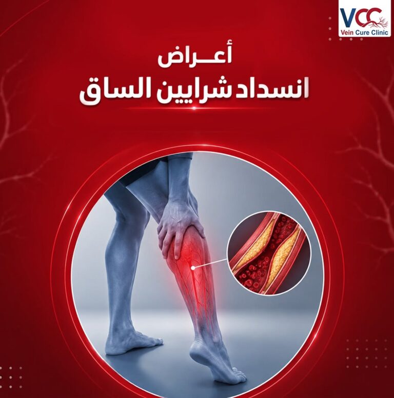 أعراض انسداد شرايين الساق