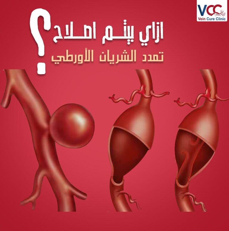 الشريان الأورطي بيتم اصلاحه ازاي !؟