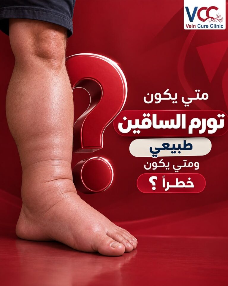 تورّم الساقين.. إمتى يكون طبيعي وإمتى يكون خطر؟