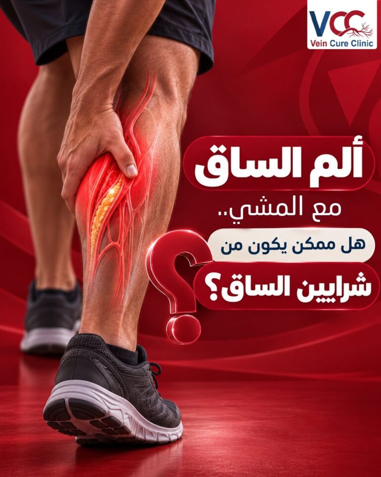 ألم الساق مع المشي.. هل ممكن يكون من شرايين الساق؟