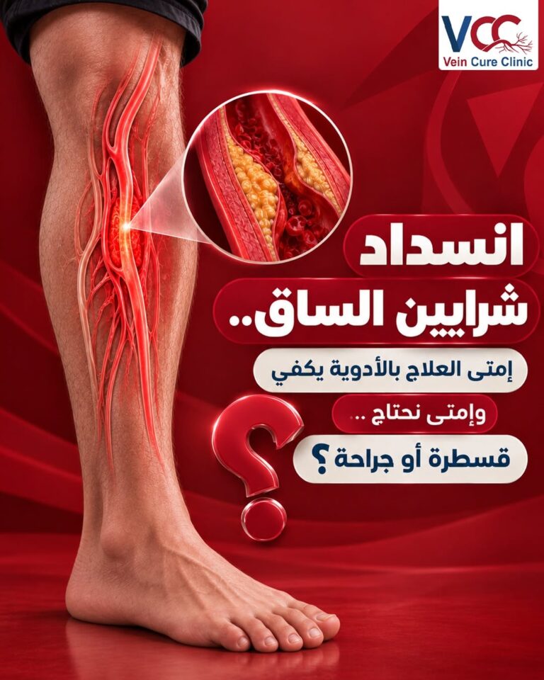 انسداد شرايين الساق.. إمتى العلاج بالأدوية يكفي وإمتى نحتاج قسطرة أو جراحة؟
